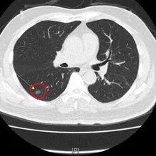 老菸槍為抱孫戒菸!檢查發現「1公分肺腺癌」撿回一命