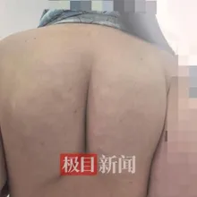 穿塑身衣猛運動！陸女狂瘦25公斤　後背竟「勒」出兩坨硬塊