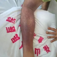 誤踩蛇窩遭狂咬12口!雲南男休克命危 5天搶救奇蹟生還