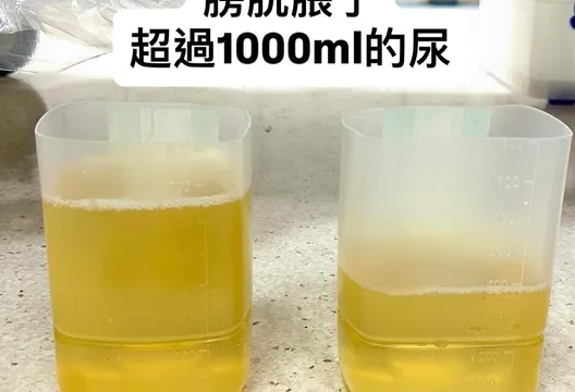 翁漏尿竟因「膀胱塞爆了」！醫：別把求救當意志力測驗