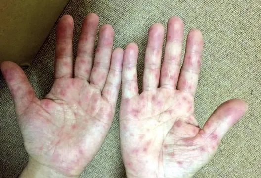 腸病毒進入好發期「今年已4重症1死」　連假後腹瀉就診恐激增