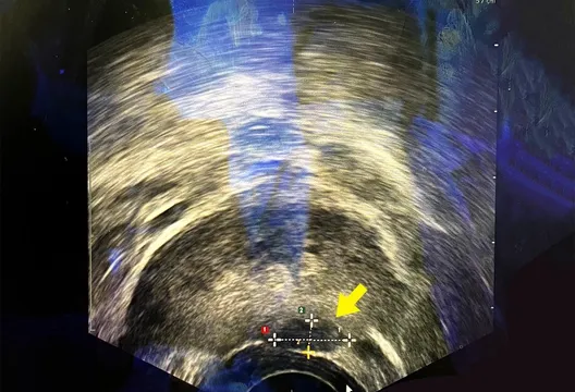 6旬男怕術後失性功能!選「海神刀」消融攝護腺癌零傷口