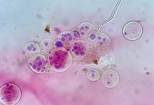 手腳痠麻、四肢無力竟是骨轉移釀神經壓迫!醫:嚴重恐癱瘓