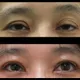 47歲女困擾10年眼瞼下垂　「提眼矯正術」變身美魔女