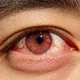 眼睛癢到抓狂恐是過敏性結膜炎！熱敷、揉眼反加重病情