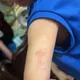 幼兒園涉虐童!家長心疼兒手臂大片瘀青 基隆市府要嚴查了