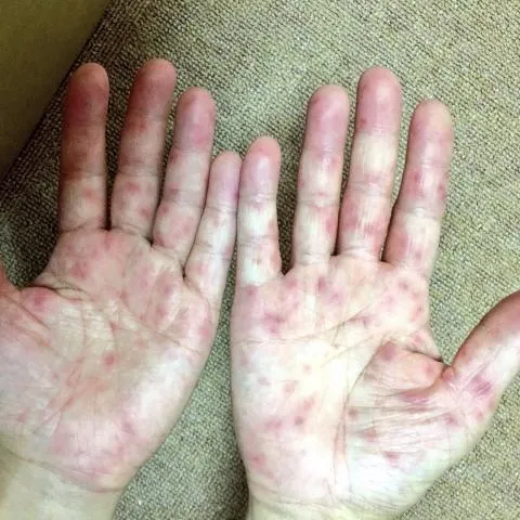 腸病毒進入好發期「今年已4重症1死」　連假後腹瀉就診恐激增