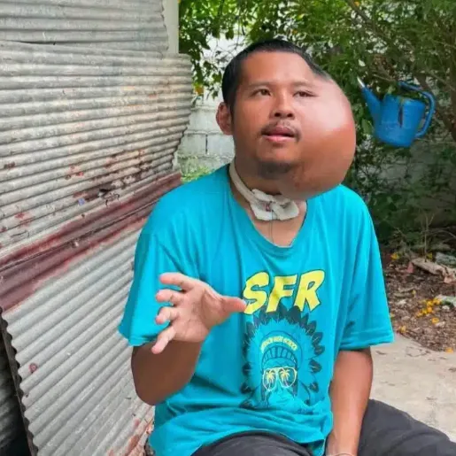 泰男牙籤剔牙「左臉長出巨大腫瘤」 求助遭酸AI造假