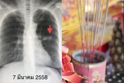 65歲女不抽菸…「每周燒20根香」拜佛　竟罹患肺癌2期
