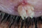 27歲男「眼皮上長肉瘤」眼科醫一看：是「菜花」右眼還冒粉色花椰菜