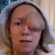 美28歲女右眼痛被誤診鼻竇炎！二度就診驚見「高爾夫球大」腫塊　右眼慘被摘除