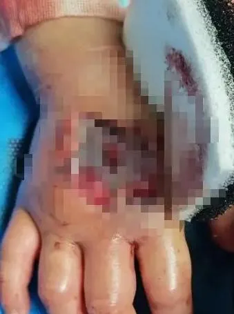 陸3歲童遭眼鏡王蛇咬傷「假死」3天　注射抗蛇毒血清後奇蹟甦醒