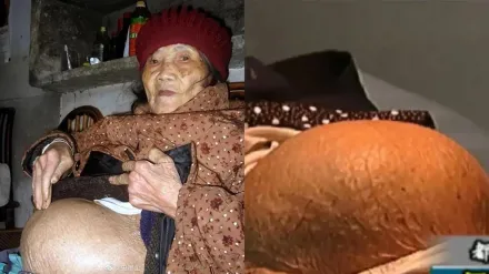 91歲阿嬤跌倒「離奇懷孕」！醫見完整胎兒震驚　一跤竟摔出60年秘密