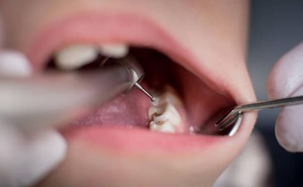 牙周病也會遺傳！33歲男牙完全不痛　牙齦和牙齒骨頭卻明顯流失
