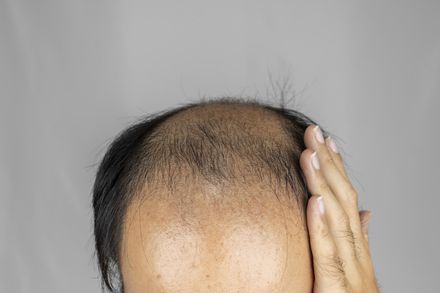 口服藥治療「雄性禿」恐影響性功能！醫：2%患者會發生