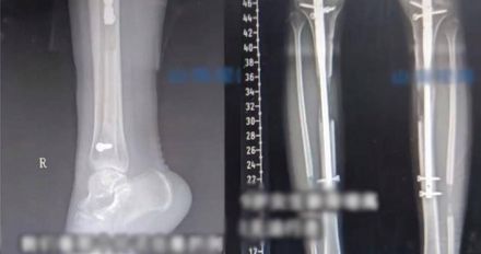 154公分小隻女做「斷骨增高手術」　術後傷口反覆感染「再也無法自行行走！」