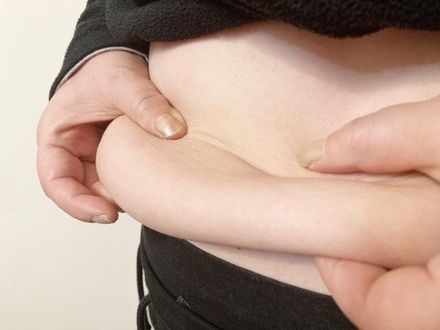 嚇死人！土耳其「胃縮小手術」竟切除92%　33歲女終身靠鼻胃管進食