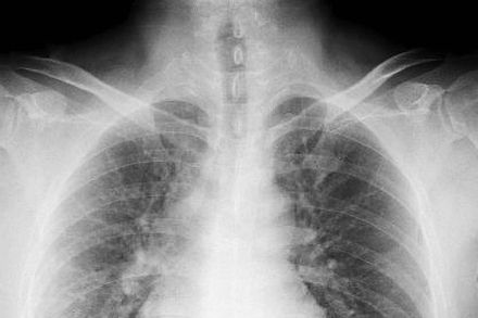 健檢X光都正常！2顆肺結節「竟是癌」　醫：再拖半年來不及救