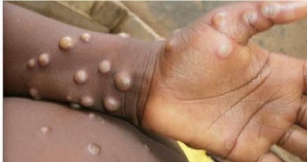 6月新增猴痘106例！陸CDC：主要通過「男男性行為」接觸傳播