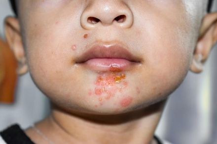 10歲孩嘴唇腫脹　組織液不斷流出是「這病」！接觸傳染　照護者要小心