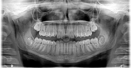 30歲女蛀牙「牙根變黑」不痛不理會　臉腫一查竟變「蜂窩性組織炎」