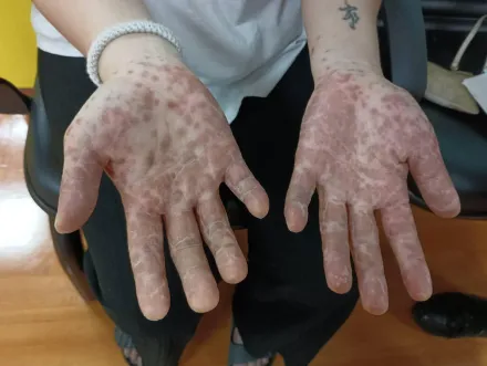 大人腸病毒也不能輕忽 ! 20多歲女雙手佈滿紅疹怵目驚心