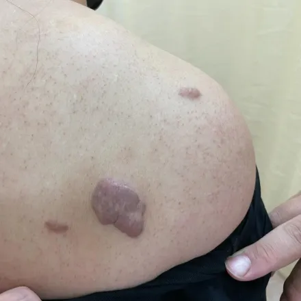 50歲女國小打球留「肥厚蟹足腫」　放射線治療告別醜疤