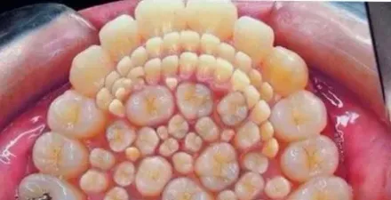有圖！5歲童罹罕病長滿「300顆牙齒」超密集照片曝