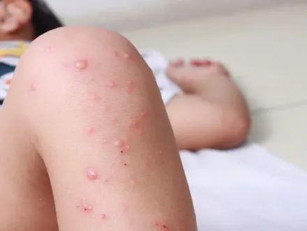 快訊/國內麻疹病例再+3！馬來西亞籍男子口腔出現白斑、發燒、紅疹