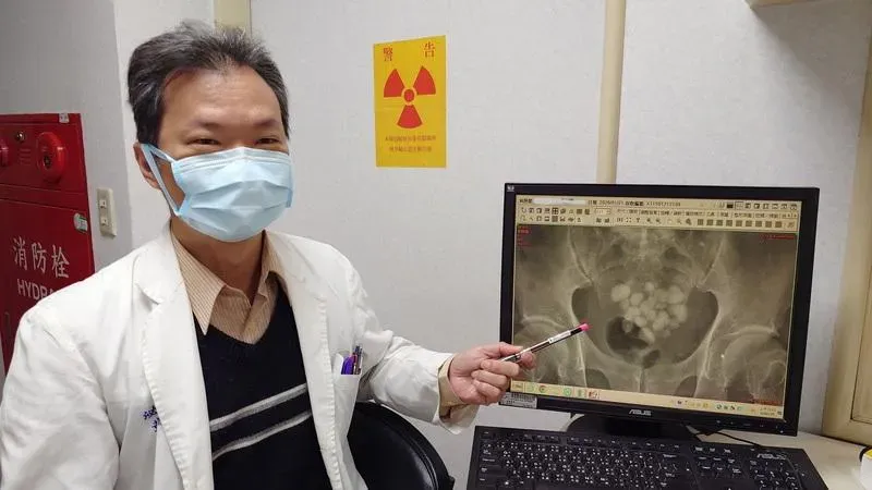 膀胱裡藏24顆鵝卵石！翁「水喝不夠」排尿困難才就醫