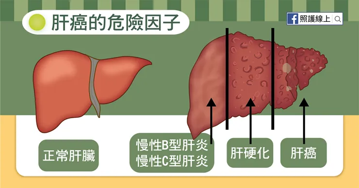 IARC報告：年增50萬例！全球肝癌病逝者上看130萬人  亞洲最多！