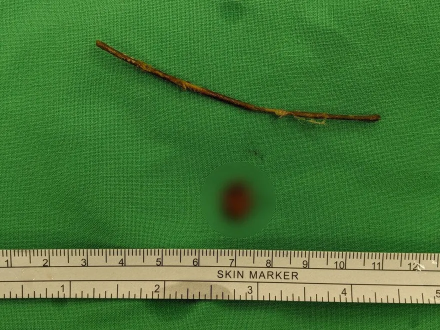 悚！1歲女童腹痛就醫　驚見「9公分樹枝」穿腸