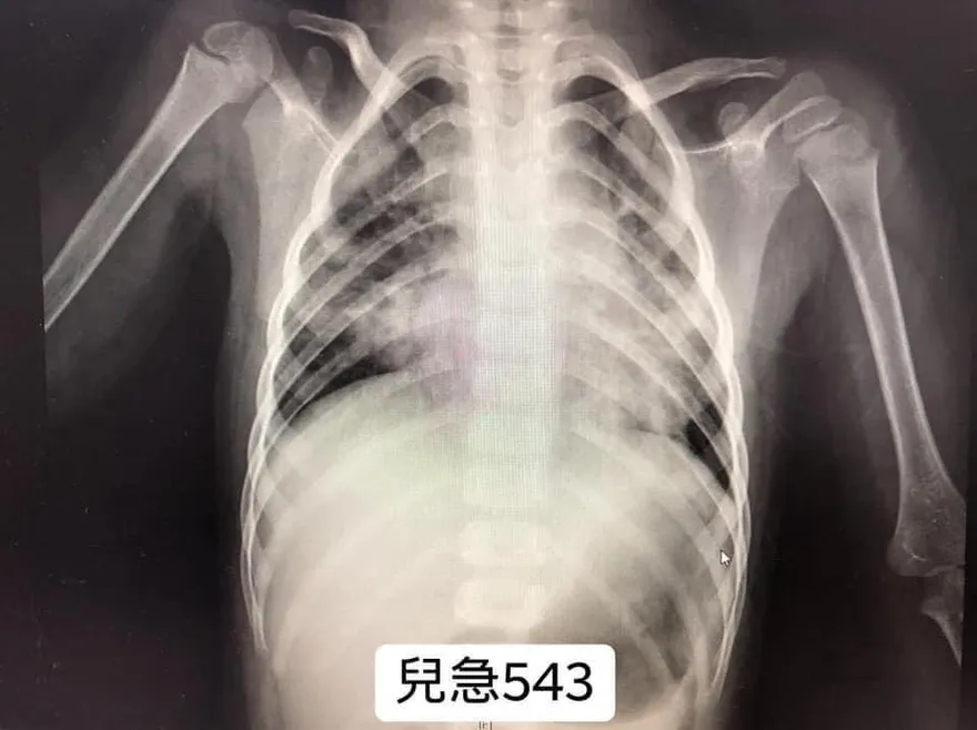 流感季節來臨　醫警告：小朋友注意！「RSV」似乎正在爆發中