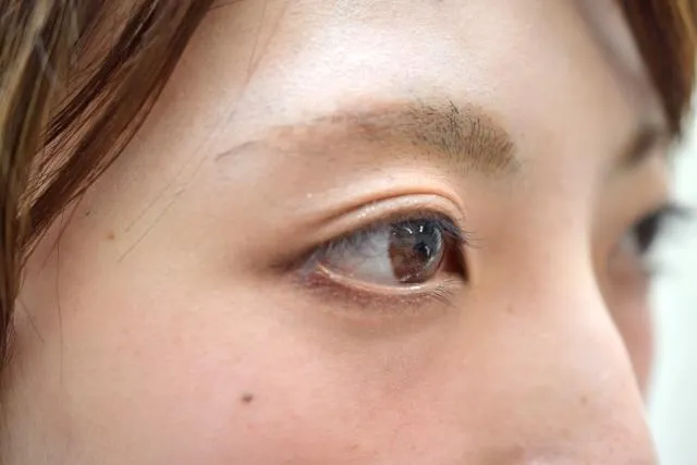雙眼皮術後好難顧！專家：只要做到這「5點」後遺症遠離你！