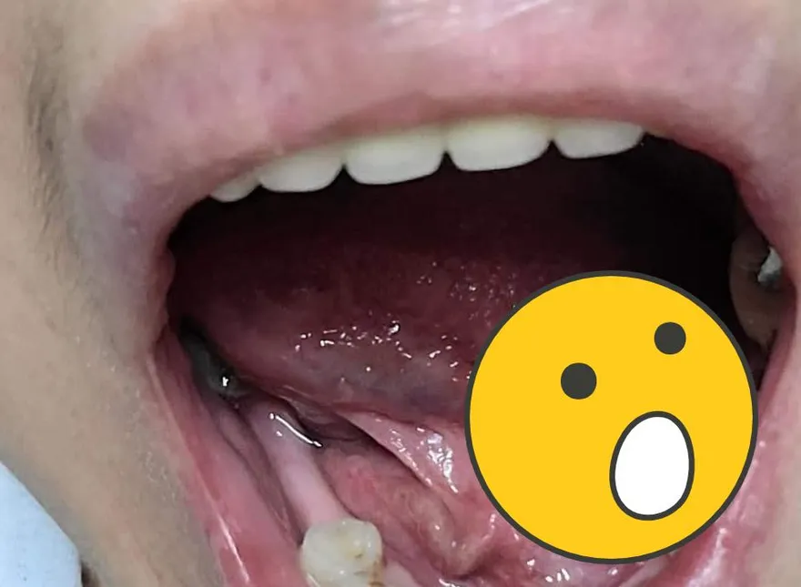 牙醫手滑鑽破口！病患傷口深到「棉花棒頭全插入」氣理論　他竟回：破皮而已