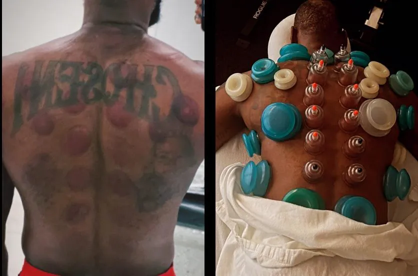 感慨東方神秘力量！詹皇享受拔罐　「背後一片花花綠綠」