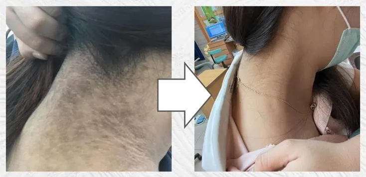 24歲女「脖子發黑」血糖飆高！醫檢查發現竟是「這1原因」