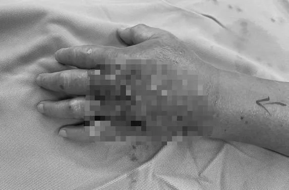 慎入！老翁被魚「刺出傷口」拖兩天腫脹、發燒　竟是「敗血性休克」險截肢！