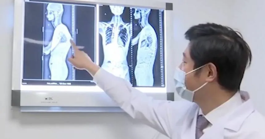 身高180突縮水10公分…他背後「有駝峰」無法躺平　醫一看驚：罹罕病