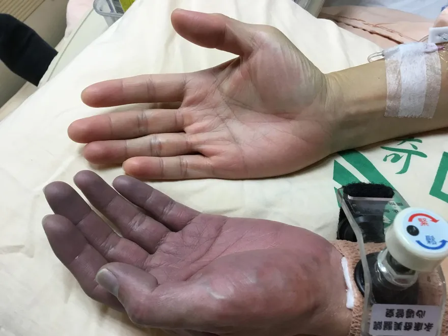 59歲男突胸痛、冒冷汗檢查發現是「心肌梗塞」　緊急治療觀察發現手竟「變黑」！