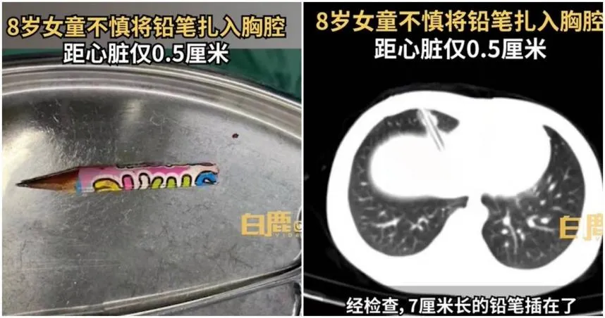 悚！女童玩耍跌倒「鉛筆插胸腔」　離心臟竟不到0.5公分！