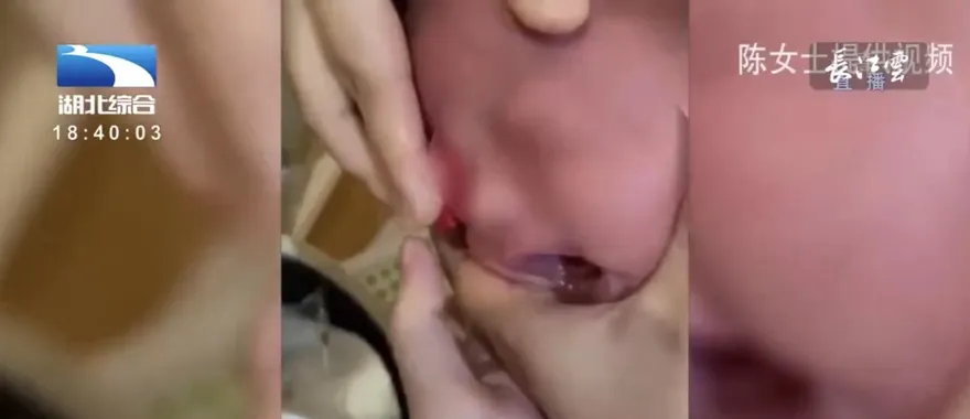 粗心月嫂拿酒精替女嬰洗眼　28天大女嬰可能一生失明