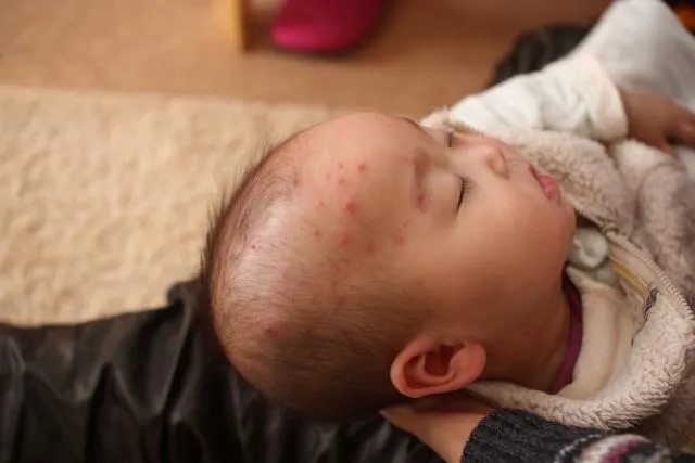 水痘拉警報！5招守護孩子健康：接種2劑疫苗保護力可達92%