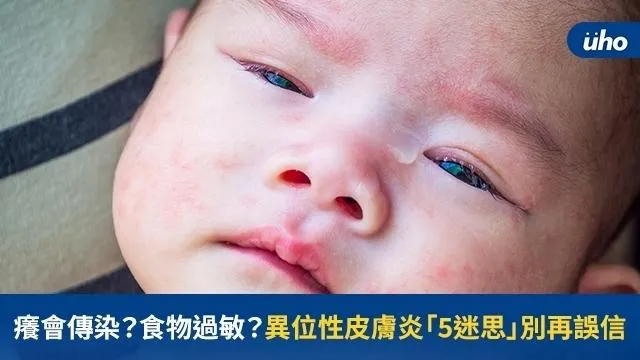 癢會傳染？食物過敏？　異位性皮膚炎「5迷思」別再誤信