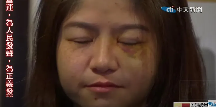 太玄宮女執事稱臉是被眼鏡刮傷　網友：怎麼看都是瘀青