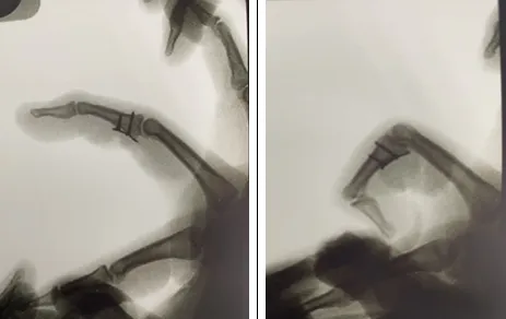 手指骨折不容小覷　醫：嚴重恐無法工作！