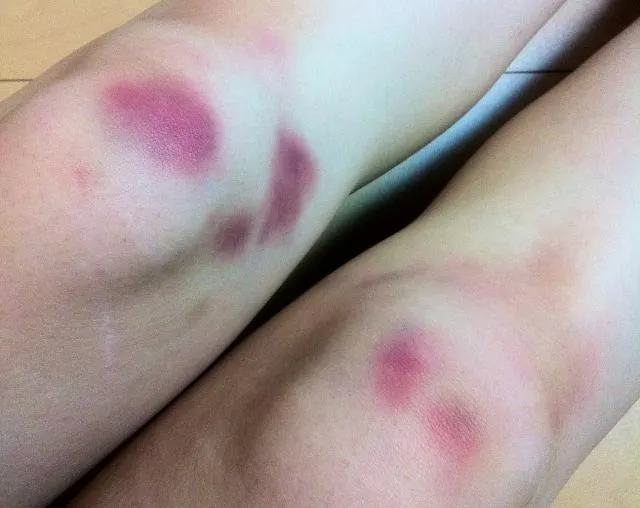 40歲女「全身瘀青」就醫傻眼竟是「肝癌」　醫揭「1狀況」要小心！