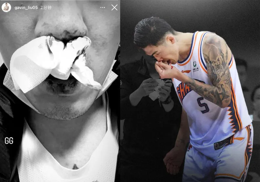 搶籃板爆鮮血！劉錚撞隊友鼻梁骨折　近日返台開刀