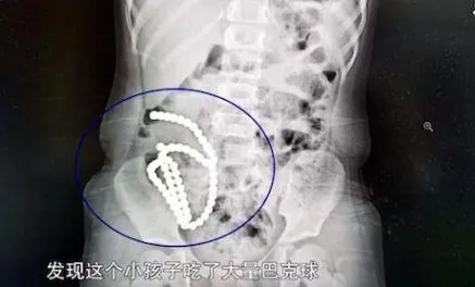 4歲女童「腹痛一個月」就醫驚見「61顆磁力球」　醫：毀了一輩子！