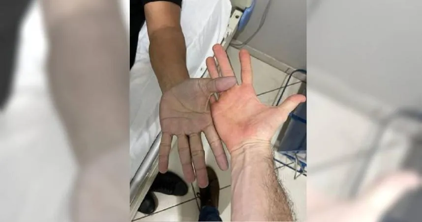 不敢相信！男子雙手突發青緊急就醫　醫詢問後笑翻「你現在就去洗手！」